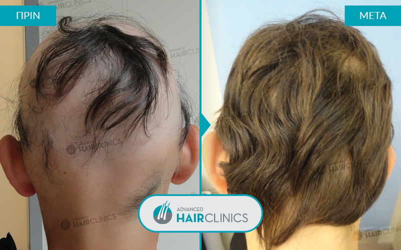 Результаты роста волос. Мезотерапия для волос. Мезотерапия волос до и после. Мезотерапия кожи головы до и после.